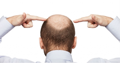 ¿Qué causa la Alopecia?