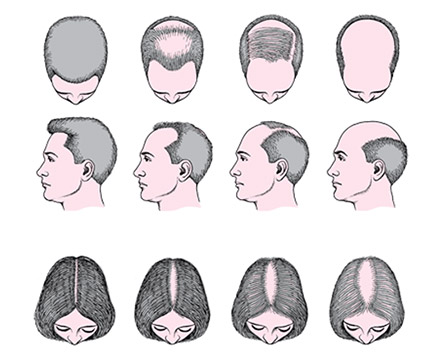 Tipos de alopecia